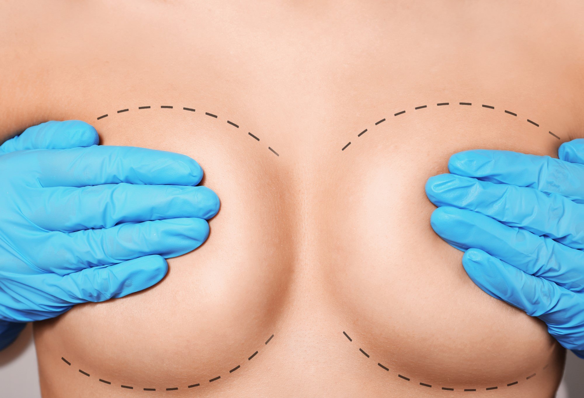 Enhancing Your Shape with Breast Augmentation and Lift by Dr. Chad Wu