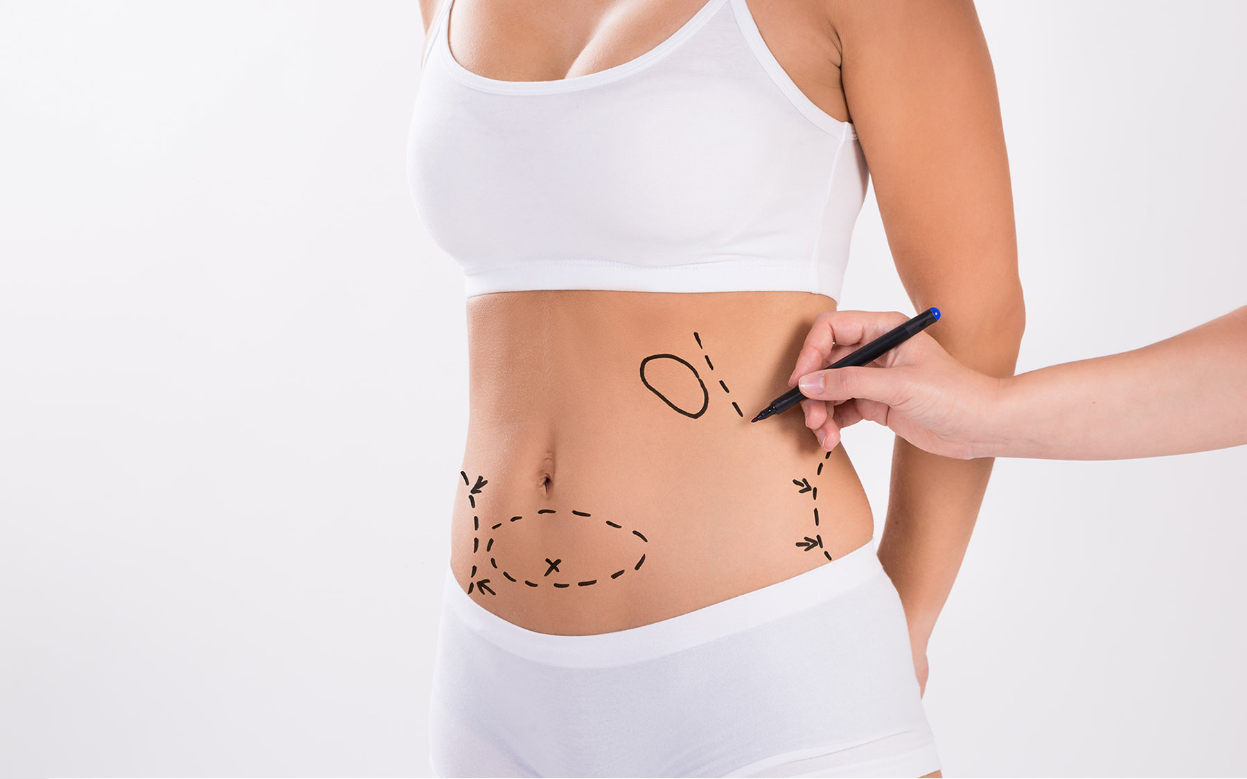 Liposuction in Richmond Hill & Downtown Toronto: Sculpt